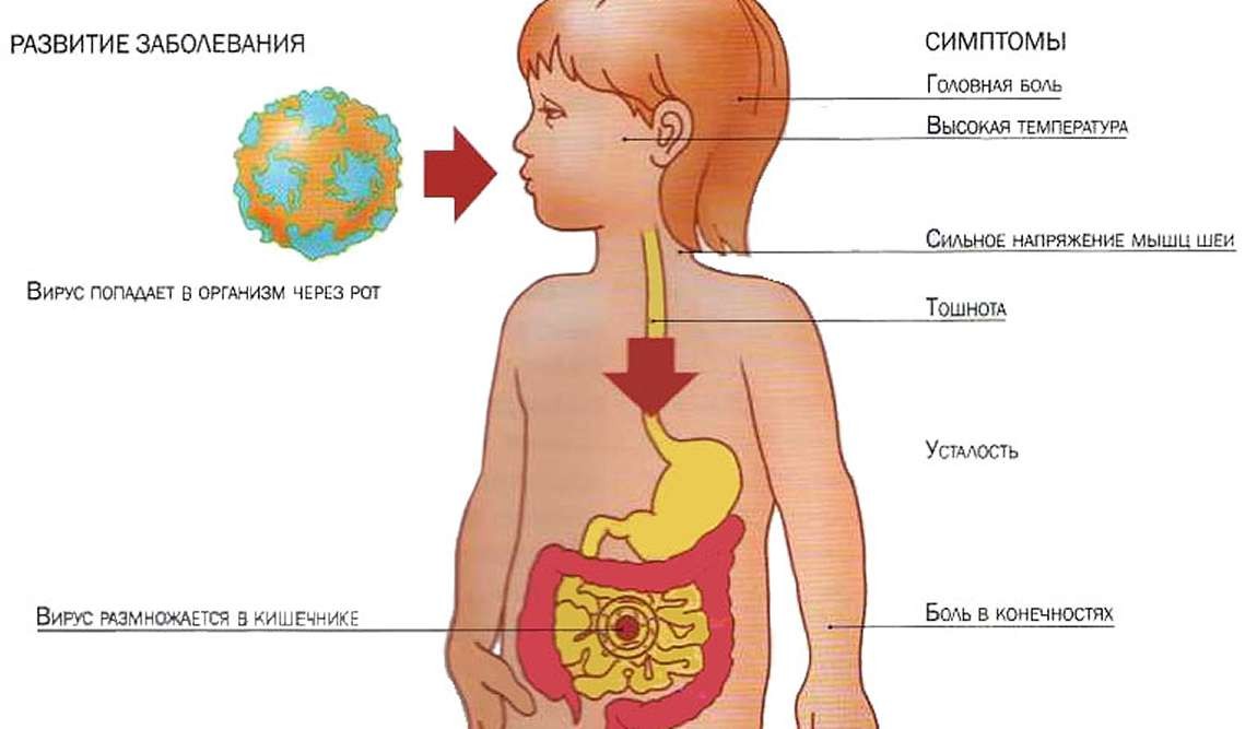 ротавирусная инфекция: симптомы и лечение у детей фото 2